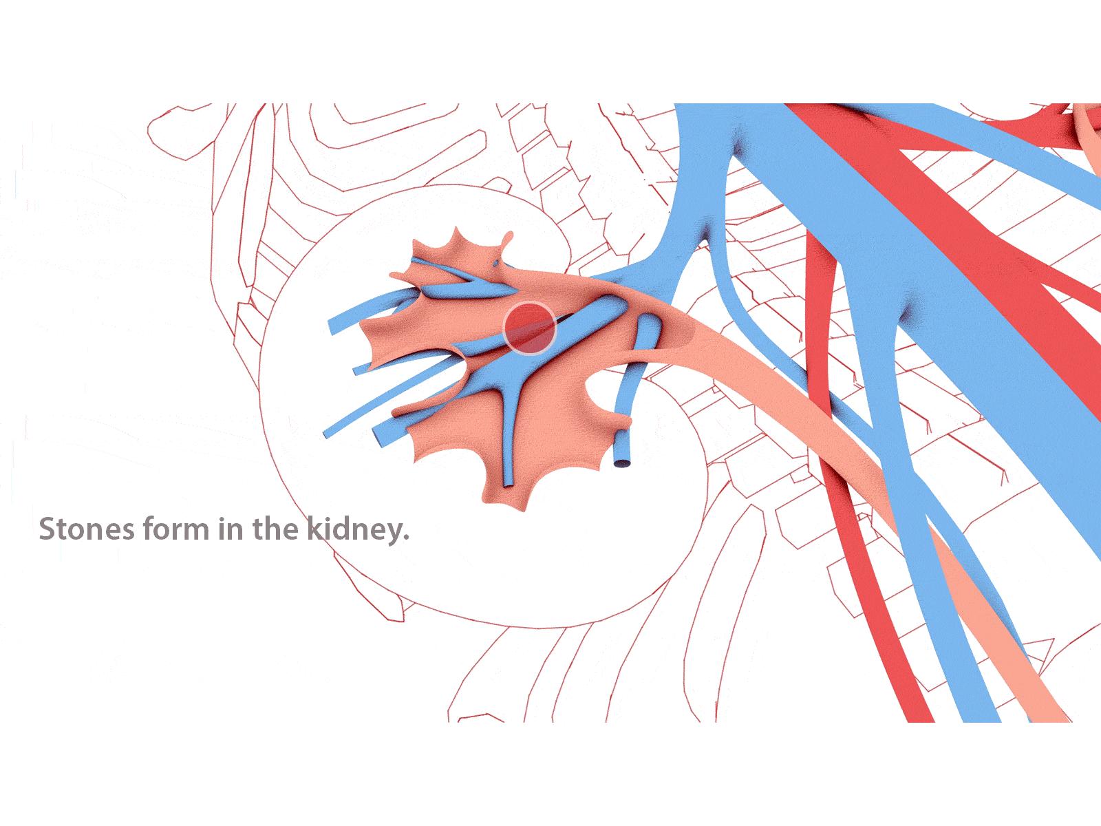 Kidney stones